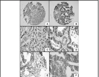 Figura 4 – Curva da sobrevida global dos pacientes com carcinomas gástricos  em relação a expressão de p53