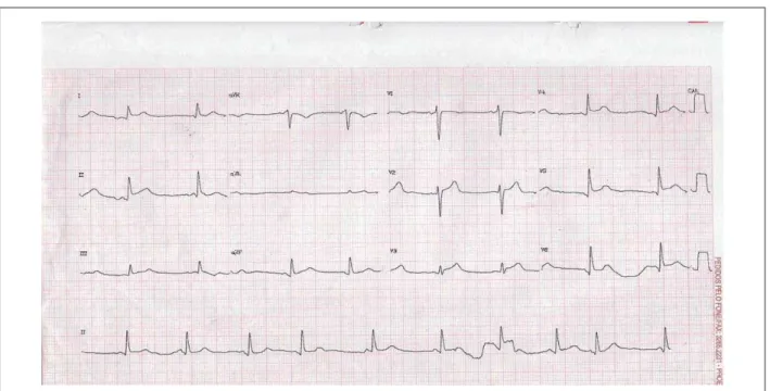 Fig. 1 - Elevation of the ST segment in the inferolateral wall