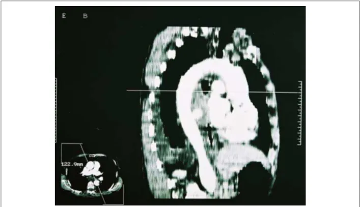 Figure 1 - High Digestive Endoscopy demonstrating mucosal ulcer measuring  around 1 cm of diameter.