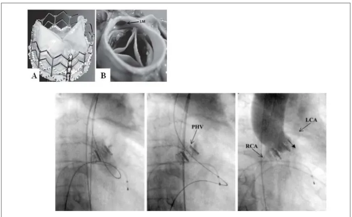 Figure 7 - PHV delivery within the native valve; A, Top view of the PHV made of pericardial lealets sutured to a balloon expandable stainless steel stent (Edwards  Lifesciences)