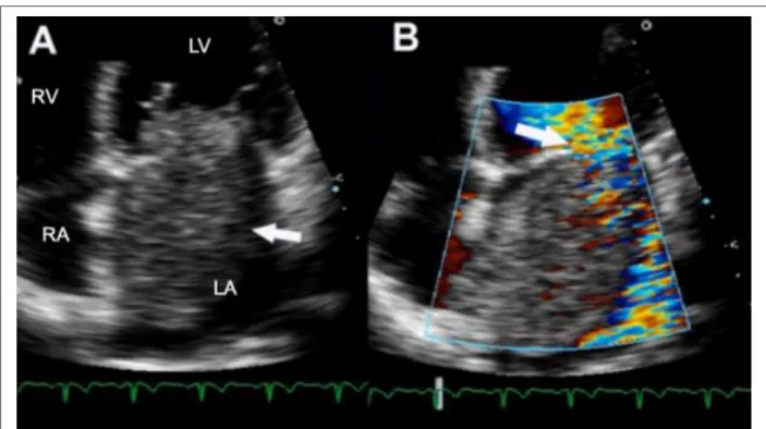 Figure 1 - ECG showing large roundish mass in left atrium, adhered to interatrial septum, projecting towards the mitral valve during ventricular diastole and resulting in  obstruction to ventricular illing (Panel A, arrow); Color low mapping (Panel B) show