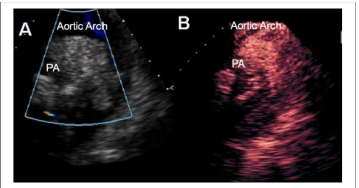Figure 3 - Transthoracic ECG showing irregular contour mass between aortic arch and pulmonary artery (A); Echocardiographic contrast injection demonstrated mass  was illed with contrast, which suggests a tumor (B); PA - pulmonary artery.