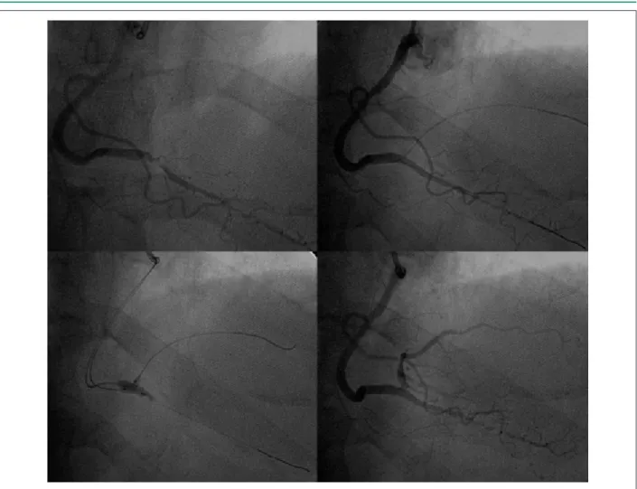 Figure 2 - Successful primary angioplasty. .