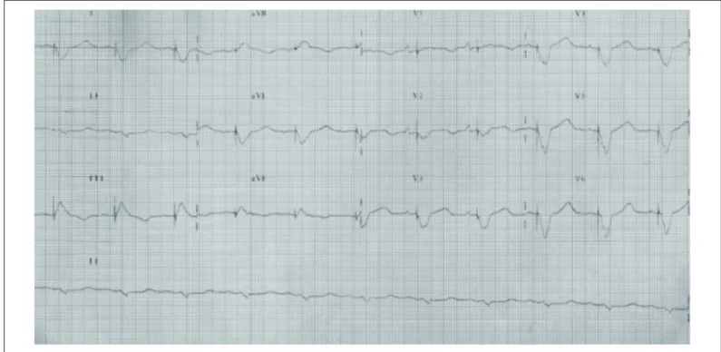 Fig. 1 - Eletrocardiograma: ritmo sinusal, marca-passo disparado por atividade atrial e estímulo ventricular por marca-passo de 200 ms.