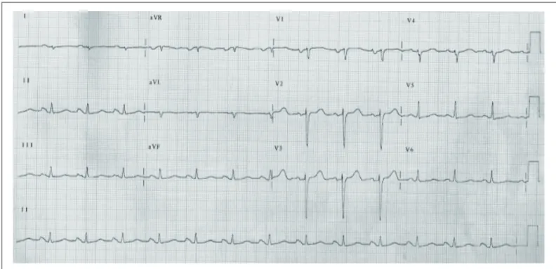 Fig. 2 - Eletrocardiograma: ritmo sinusal, sinais sugestivos de sobrecarga atrial esquerda e diminuição de forças septais.