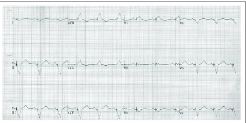 Fig. 4 -  Eletrocardiograma: ritmo sinusal, com estímulo ventricular por marca-passo no início e meio do QRS, compatível com estimulação ventricular em dois sítios.
