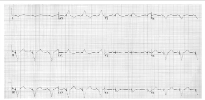 Figure 4 -  ECG- sinus rhythm, with ventricular stimulation by the pacemaker at the start and middle of the QRS, compatible with ventricular stimulation in two sites