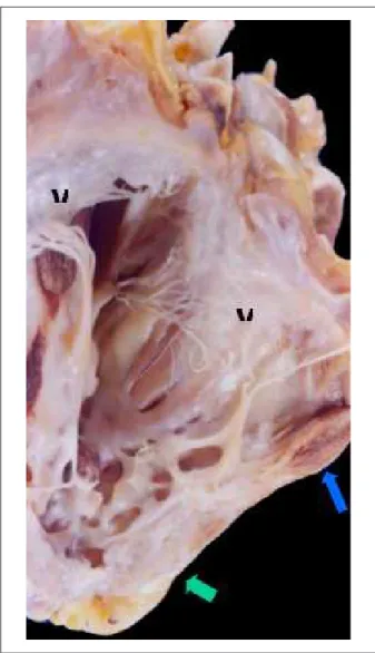 Figure  6  -  Macroscopic  aspect  of  the  heart,  showing  the  open  right  ventricle, which is dilated, with extensive areas of fibrosis (green arrow: 