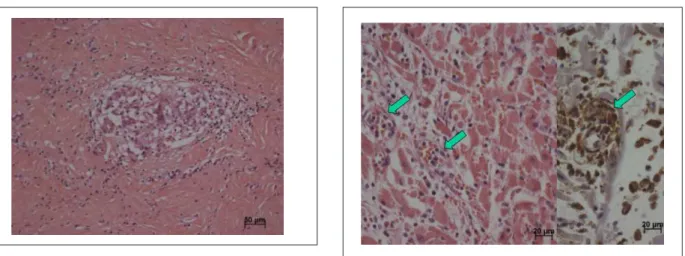 Figure 8 - Histological cut of the myocardium of the transplanted heart, showing  extensive inlammatory mononuclear iniltrate and aggression and necrosis of  myocardiocytes