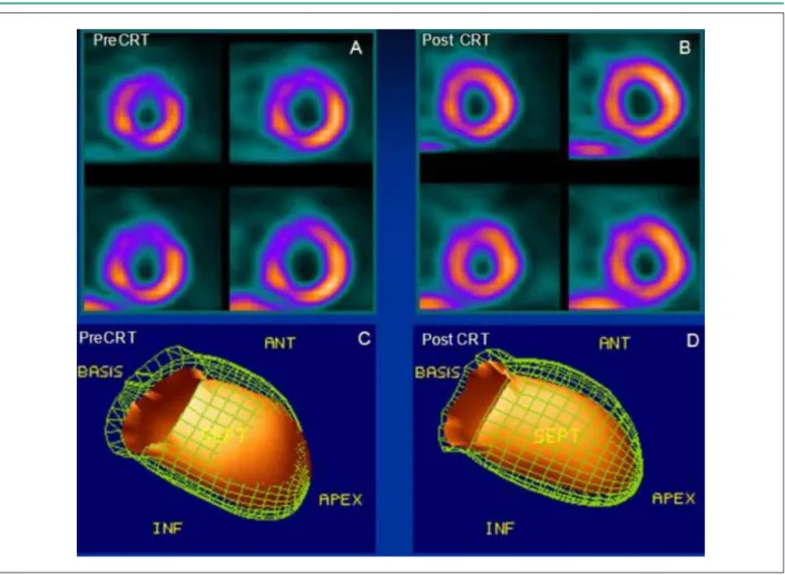 Figure 1 - A - Short axis views of the single photon emission computed tomography (SPECT) of the left ventricle (LV) with MIBI- 99m Tc pre-cardiac resynchronization  therapy (CRT); Upper rows: images obtained after pharmacological stress with dipyridamole;