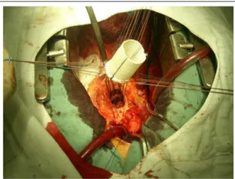Figure  2  - Conduit  totally  implanted  in  the  interior  of  the  aorta  and  being  sutured below the coronary ostia.