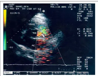 Figure  1  - Transthoracic bidimensional echocardiogram with color low; 