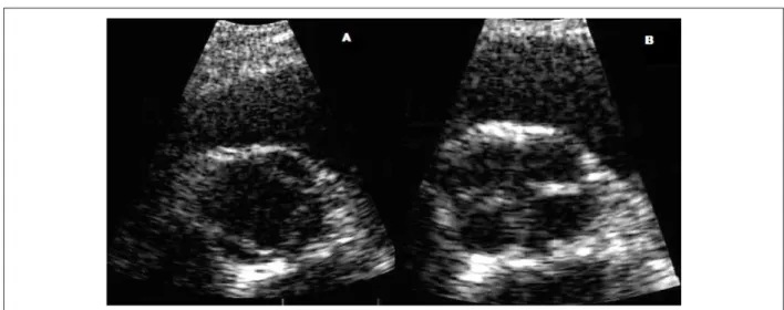 Figure 2 - Doppler image of regurgitant low.