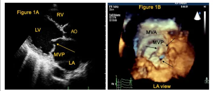 Figure 1 - 2-D (Figure 1A) and 3-D ECHO (Figure 1B) of a patient with mitral valve prolapse (MVP); Single arrow indicating the lack of lealet coaptation; double arrow  (Figure 1B) showing MVP, as seen from the left atrium; MVA - Mitral valve annulus.