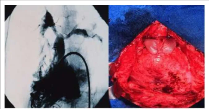 Figure 2 - Compression of the left pulmonary artery and pulmonary trunk by the 