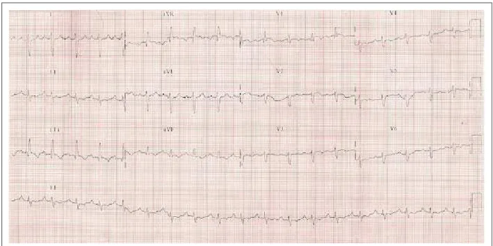 Figure 1 – ECG - sinus tachycardia, right bundle branch block, right axis deviation, and a S 1 Q 3 T 3  pattern.