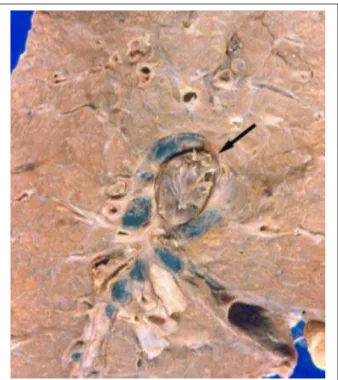 Figure 3 - Longitudinal section of the right lung at the hilar level showing  occlusion of the pulmonary artery by a fresh thrombus (arrow).