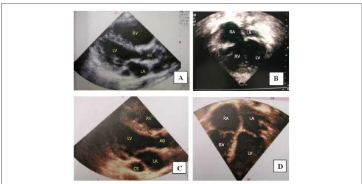 Figure 1 - Echocardiogram shows an enlargement of right cavities and a reduction in the size of left cavities especially of the left atrium in the preoperative period in a  longitudinal parasternal section in A and in an apical section of four chambers in 