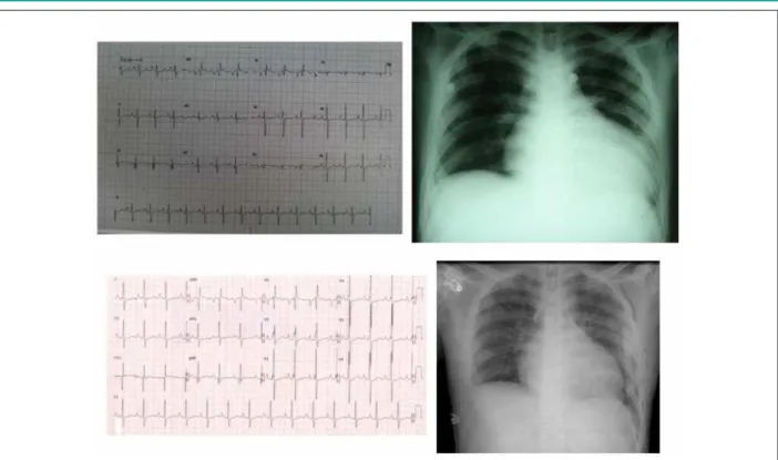 Figure 1 - Above - Preoperative ECG and chest x-Ray; below - postoperative ECG and chest x-Ray.