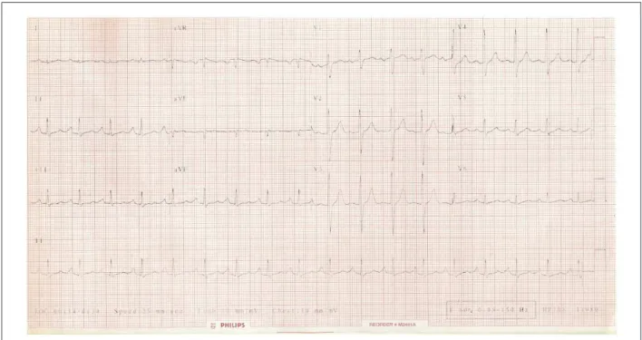 Fig. 1 - ECG. Taquicardia sinusal, sobrecarga atrial esquerda e sobrecarga de ventrículo direito.