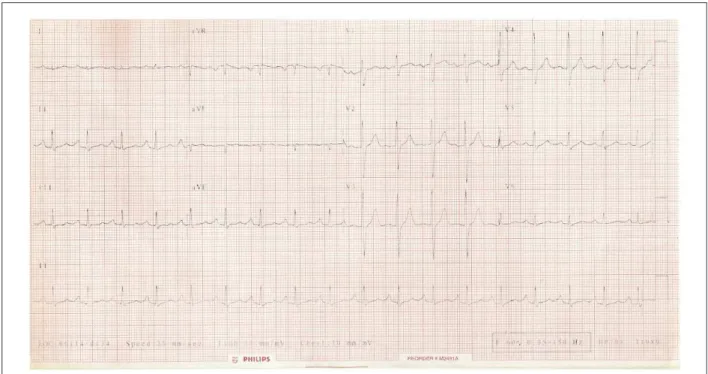 Figure 1 - ECG. Sinus tachycardia, left atrial overload and right ventricular overload.