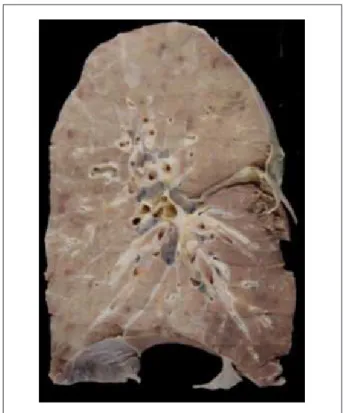 Figure 4 - Sectioned surface of the right lung, showing diffuse thickening of  the parietal pleura and increased hilar lymph node volume.