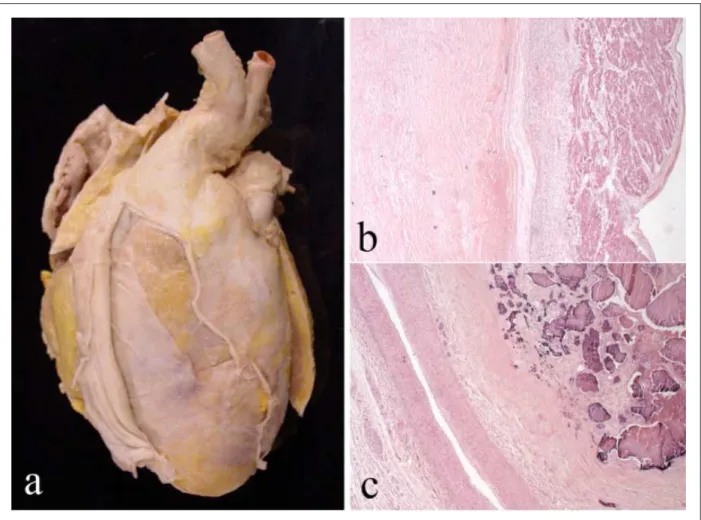 Figura 2 - a - Aspecto externo del corazón, mostrando pericarditis constructiva con adherencia entre los velos visceral y parietal; b) fotomicrografía del corazón  en el plano atrial, donde se observa que el pericardio (mitad izquierda del panel) tiene un 