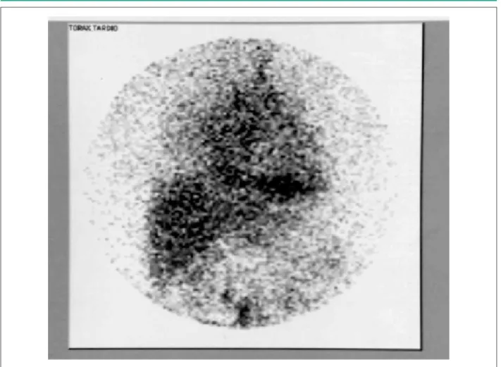 Figure 2 -  Lymphoscintigraphy: abnormal thoracic radiopharmaceutical accumulation
