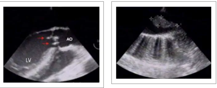 Figure 2 - Echocardiogram demonstrating vegetation at the aortic coarctation  level.