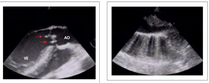 Figura 1 - El ecocardiograma evidencia la vegetación al nivel de la válvula  aorta bicúspide.