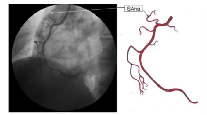 Figura 1 - Arteria coronaria derecha en la posición oblicua anterior izquierda, mostrando la rama del nódulo sinusal