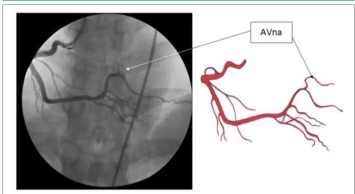 Figura 3 -  Arteria coronaria derecha en la posición oblicua anterior izquierda, mostrando la rama del nódulo atrioventricular; AnAV - arteria del nódulo atrioventricular.