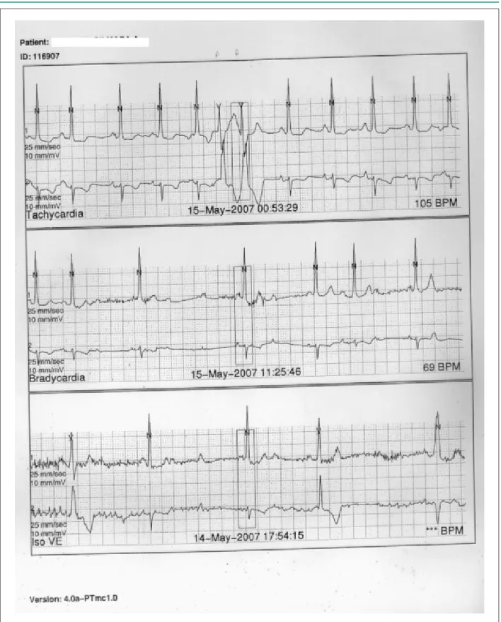 Figure 2 -  Holter monitoring showing period of intermittent 2:1 atrioventricular block and episodes of advanced atrioventricular block.