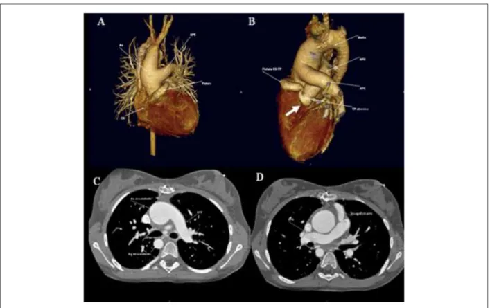 Fig. 1 -  Reconstrução tridimensional de Angiotomograia de tórax demonstra origem aórtica da artéria pulmonar esquerda (A-Visão anterior) e atresia valvar pulmonar  (seta grossa) com tronco pulmonar suprido por fístula oriunda da coronária direita com dila