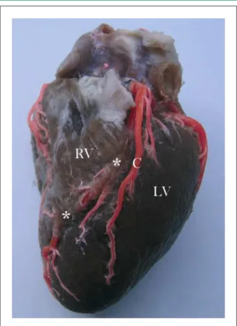 Figure 1 - Sternocostal heart surface. Anterior interventricular artery with two  myocardial bridges (*)