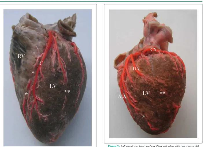 Figure  2  - Sternocostal  heart  surface. Anterior  interventricular  artery  with  two  myocardial  bridges  (*)