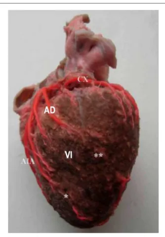 Figura  5  -  Superficie esternocostal del corazón. Arteria interventricular  anterior con un puente miocárdico (*)
