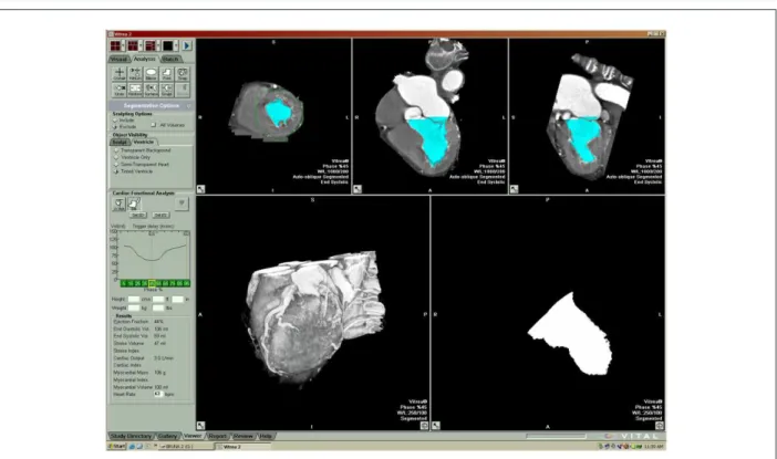 Figure 2 - Tomographic image of the left ventricle (short axis, 4 and 2 chambers) for the determination of reference points for ventricular volume measurement  (in blue).