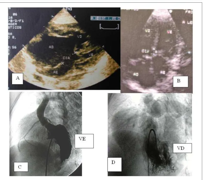 Fig. 2 -  Imagens ecocardiográicas em projeção de quatro câmaras em A (pré-operatório) e em B (três meses após a correção) com contraste nítido do tamanho das  cavidades esquerdas
