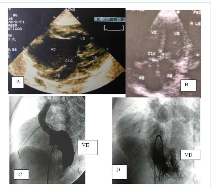 Figura 2 -  Imágenes ecocardiográicas en proyección de cuatro cámaras en A (preoperatorio) y en B (tres meses después de la corrección) con contraste nítido del  tamaño de las cavidades izquierdas