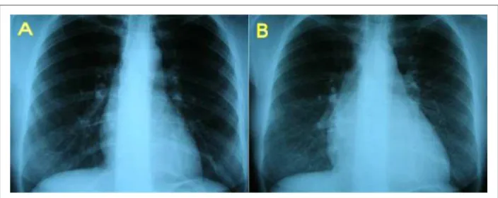 Figura 2 - Ecocardiograma bidimensional en posición cuatro cámaras. Se puede observar la envoltura reumática de la válvula mitral, con puntos de calciicación en  los velos, y espesor de la válvula tricúspide; VD - ventrículo derecho; VI - ventrículo izquie