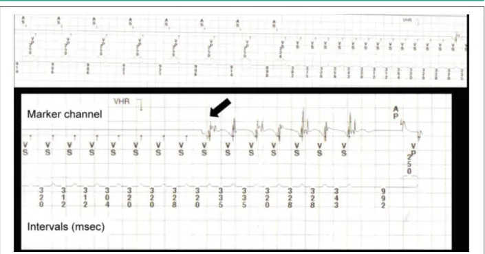 Figure 2 - Ventricular tachycardia with 2:1 VA conduction; VS - ventricular sensing; V - ventricular electrogram; A - atrial electrogram.