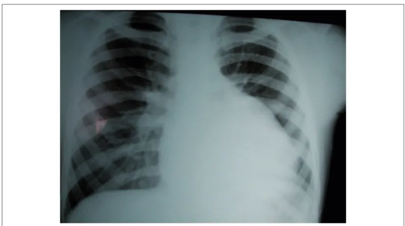 Fig. 2 - Ecocardiograma mostrou em projeção paraesternal esquerda, em corte transversal, dilatação da via de saída de VD e das artérias pulmonares, com interposição  de monocúspide calcifi cada – em A – e sinais de regurgitação pulmonar acentuada, por colo