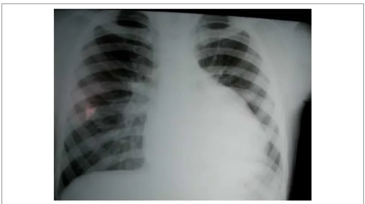 Figure 2 - Echocardiogram showing in the left parasternal projection in a cross-sectional view, the dilation of the right ventricular (RV) outlow tract and the pulmonary  arteries, with interposition of calciied monocusp in A and signs of marked pulmonary 