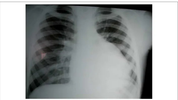 Figura 2 - Ecocardiograma, en proyección paraesternal izquierda y corte transversal, mostró dilatación del tracto de salida de VD y de las arterias pulmonares, con  interposición de monocúspide calciicada –en A– y señales de regurgitación pulmonar acentuad
