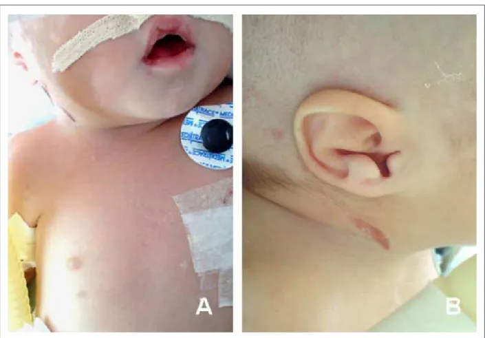 Table 1 – Reports of BOFS associated with congenital heart defects described in the literature