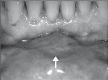 Figura 1  – Caso 2. Aspecto clínico da amiloidose bucal mostrando aumento de volume em mucosa vestibular anterior (seta branca, região de incisivos inferiores)