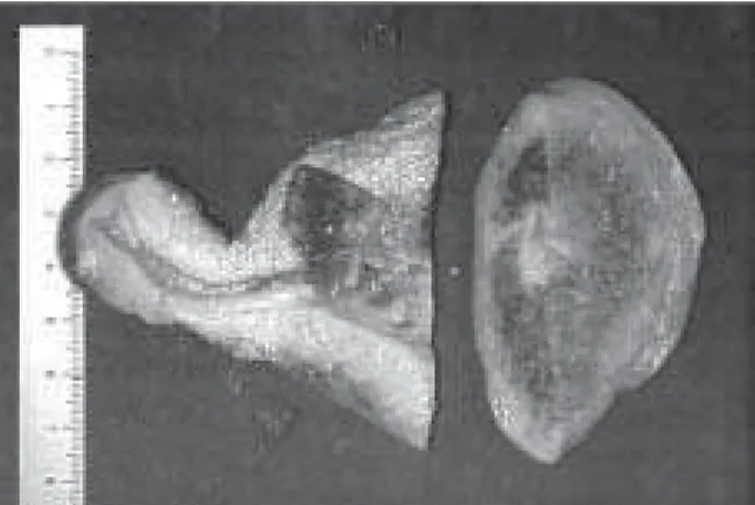 Figura 1  – Peça anatômica mostrando a parede miometrial sendo invadida por