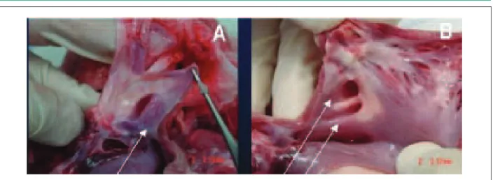 Figure 4 – Pathological images showing examples of gaps. Arrows show gaps at the sites of leaks seen at the ICUS in the RSPV (A) and LSPV (B).