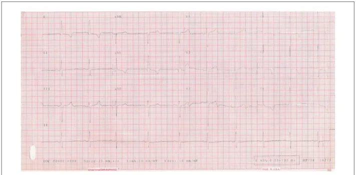 Fig. 2 – Electrocardiogram: sinus rhythm, left-bundle branch block and of its anterosuperior division, left-chamber overload and secondary alterations of ventricular  repolarization.